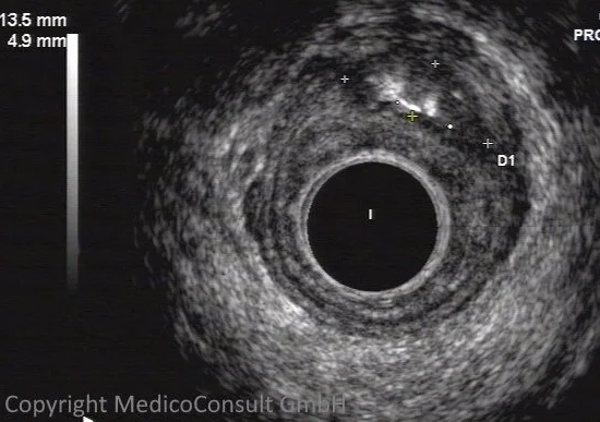 Präanaler Rektumabszess Endosonographie