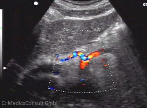 Sono Oberbauch quer Coeliaca Schwalbenschwanz
