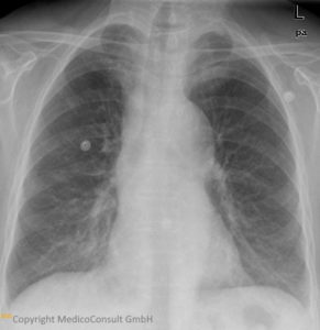 Morbus Hodgkin (Röntgenbild der Lungen)