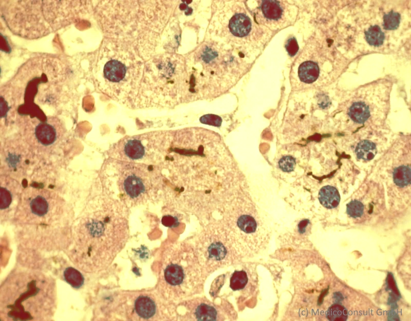 Cholestase Gallenkapillaren
