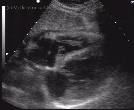 Herz von abdominell Sono