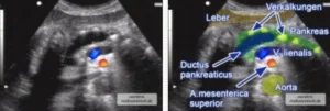 Chronische Pankreatitis Erweiterter Pankreasgang Pankreasverkalkungen Sonographie