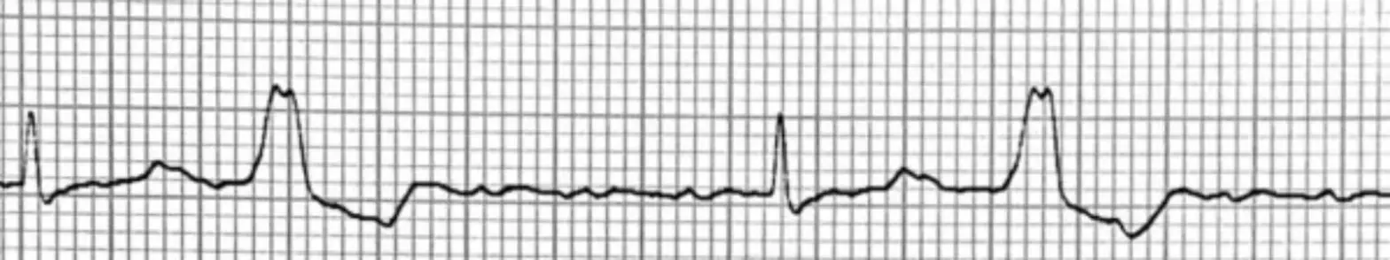 Vorhofflattern EKG