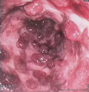 Colitis ulcerosa: Kolonschleimhaut mit Prseudopolypen (Koloskopie)