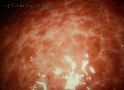 Chronisch aktive Hepatitis Leberfibrose Laparoskopie