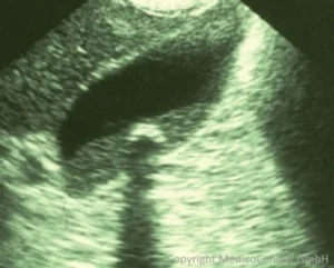 Gallenstein und Sludge