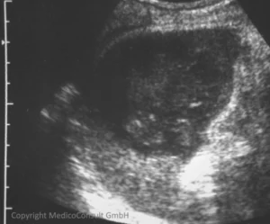 Milzabszess (Sonographie)