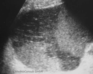 Milzinfarkte (Sonographie)