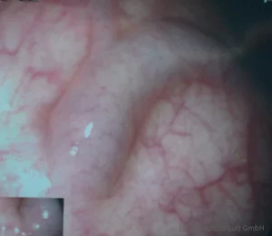 Rektalvarize bei Leberzirrhose