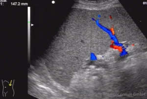 Splenomegalie bei Leberzirrhose (Sonographie)
