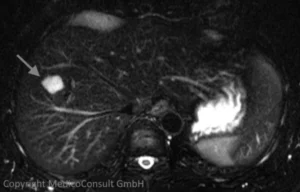 Leberhämangiom MRT T2-Wichtung