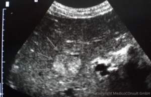 Leberhämangiom Sonographie