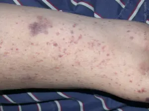 Petechien Thrombopenie