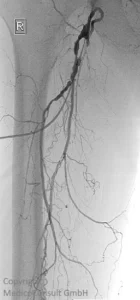 Arteriosklerose Verschlusskrankheit Angiographie