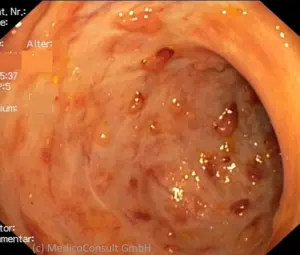 Pseudopolypen bei Colitis ulcerosa